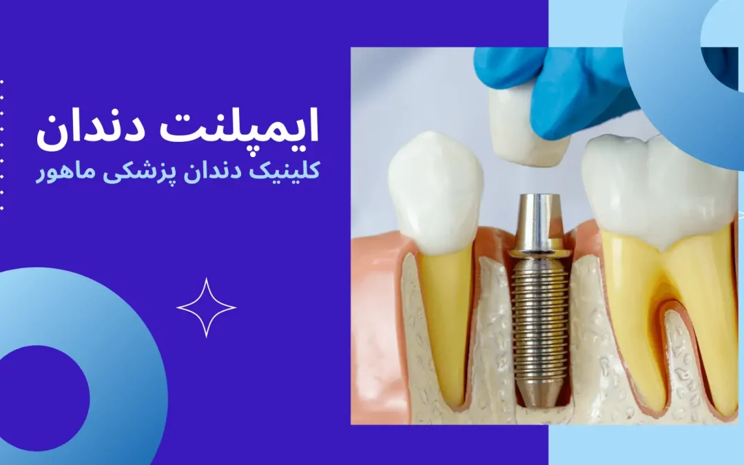 انجام کلیه خدمات ایمپلنت دندان در کلینیک دندان پزشکی ماهور